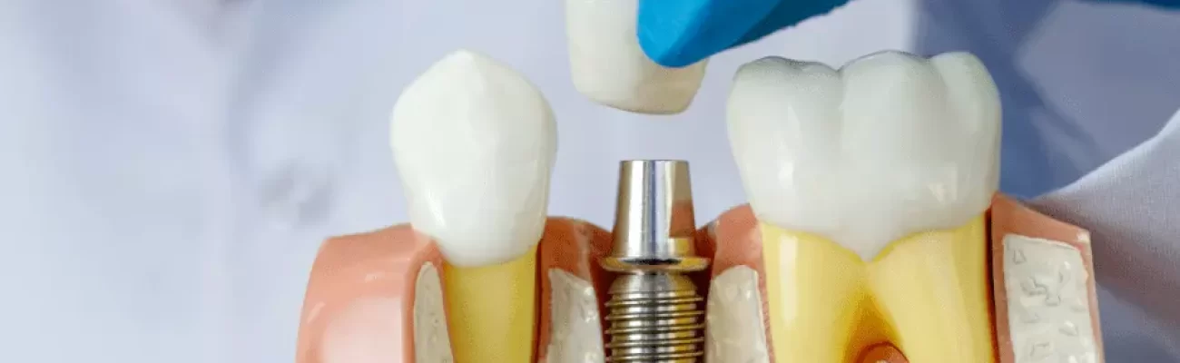 کاشت دندان و پروتزهای دندانی2