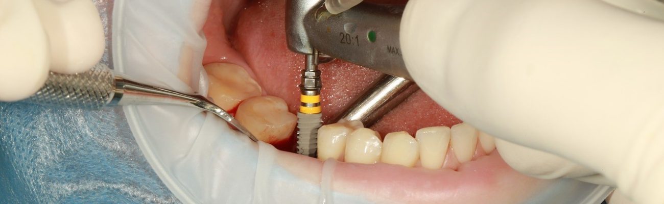 کاشت دندان و پروتزهای دندانی3